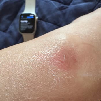 Apple Watch Kullanımı Sonrası Bilekte Ciddi Tahriş Ve İlgisizlik Mağduriyeti