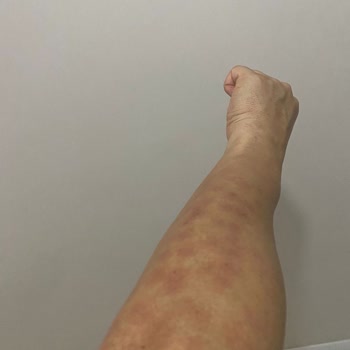Lazer Epilasyon Sonrası Ciddi Yanık Ve Renk Bozukluğu, Klinik Sorumluluk Almıyor
