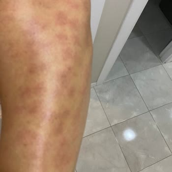 Lazer Epilasyon Sonrası Ciddi Yanık Ve Renk Bozukluğu, Klinik Sorumluluk Almıyor