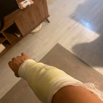 Lazer Epilasyon Sonrası Ciddi Yanık Ve Renk Bozukluğu, Klinik Sorumluluk Almıyor