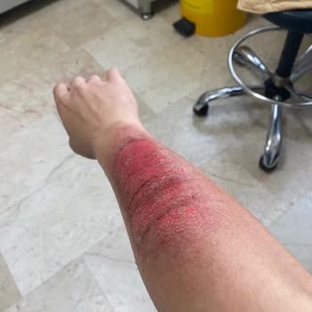 Lazer Epilasyon Sonrası Ciddi Yanık Ve Renk Bozukluğu, Klinik Sorumluluk Almıyor
