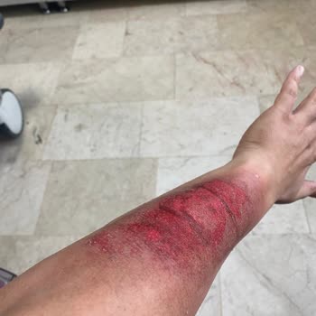 Lazer Epilasyon Sonrası Ciddi Yanık Ve Renk Bozukluğu, Klinik Sorumluluk Almıyor