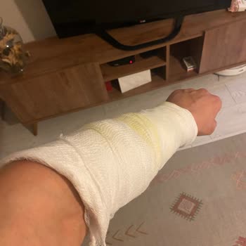 Lazer Epilasyon Sonrası Ciddi Yanık Ve Renk Bozukluğu, Klinik Sorumluluk Almıyor