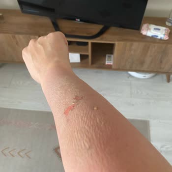 Lazer Epilasyon Sonrası Ciddi Yanık Ve Renk Bozukluğu, Klinik Sorumluluk Almıyor