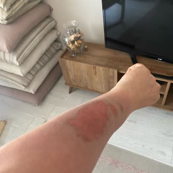 Lazer Epilasyon Sonrası Ciddi Yanık Ve Renk Bozukluğu, Klinik Sorumluluk Almıyor