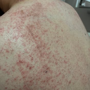 Agiss Erkek Tüy Dökücü Krem Ciltte Ciddi Tahriş Ve Yanma Yaptı