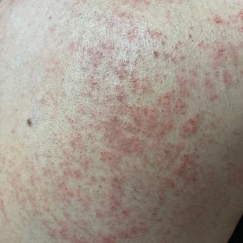 Agiss Erkek Tüy Dökücü Krem Ciltte Ciddi Tahriş Ve Yanma Yaptı