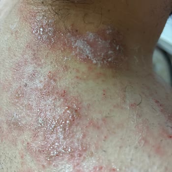 Agiss Erkek Tüy Dökücü Krem Ciltte Ciddi Tahriş Ve Yanma Yaptı