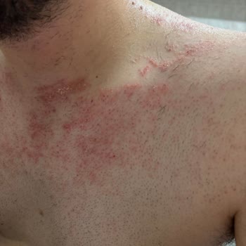 Agiss Erkek Tüy Dökücü Krem Ciltte Ciddi Tahriş Ve Yanma Yaptı