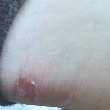 Aldığım Ayakkabı Ayağımı Yaraladı, İade Talebim Reddedildi