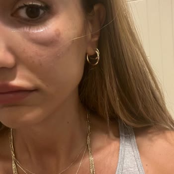 Estpoint Yüzümde Uzun Süre Geçmeyen Morluklar Ve Klinik Tarafından İlgisizlik!