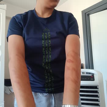 Randevuya Rağmen Bekletildim Ve Annem Odaya Alınmadı, İşlemde Acı Çektim