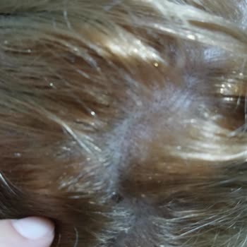 Saç Boyası Sonrası Ciddi Yanma, Kabuklanma Ve Kanama Yaşadım