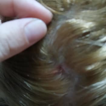 Saç Boyası Sonrası Ciddi Yanma, Kabuklanma Ve Kanama Yaşadım