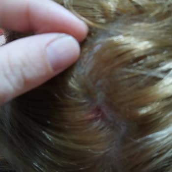 Saç Boyası Sonrası Ciddi Yanma, Kabuklanma Ve Kanama Yaşadım