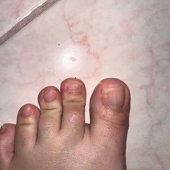 Pedikür Sonrası Tırnak Mantarı Ve Sağlık Sorunu Yaşadım