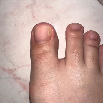 Pedikür Sonrası Tırnak Mantarı Ve Sağlık Sorunu Yaşadım