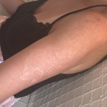 Sahte Güneş Kremi Yüzünden Mağduriyet Ve Sağlık Riski