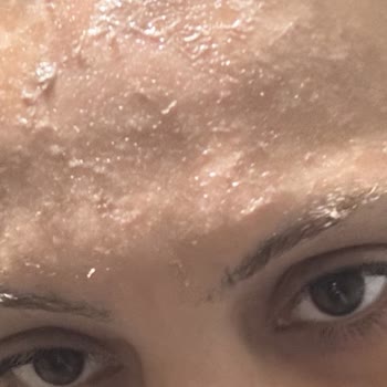 Sahte Güneş Kremi Yüzünden Mağduriyet Ve Sağlık Riski