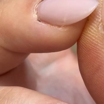 Jel Tırnak Uygulaması Sonrası Deformeler Ve İletişimsizlik Mağduriyeti