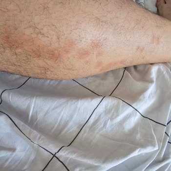 I Was Attacked by Bed Bugs in a Berlin Booking.com Rental and Only Got 30% Refund