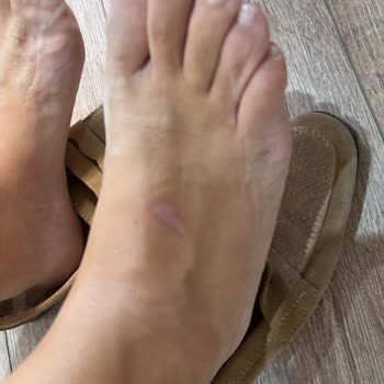 Sandalet Ciddi Yara Yaptı, Mağaza İlgisiz Kaldı Çözüm Bekliyorum