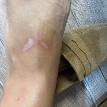 Sandalet Ciddi Yara Yaptı, Mağaza İlgisiz Kaldı Çözüm Bekliyorum