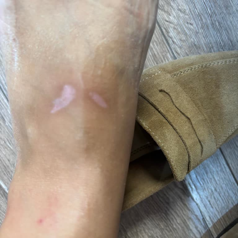 Sandalet Ciddi Yara Yaptı, Mağaza İlgisiz Kaldı Çözüm Bekliyorum