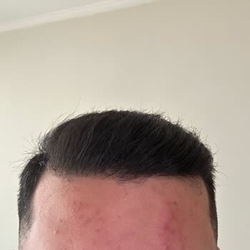 Eczaneden Alınan Yüz Yıkama Jeli Cildimi Bozdu, İlgisiz Yaklaşım