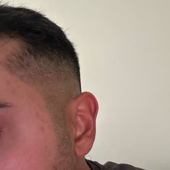 Eczaneden Alınan Yüz Yıkama Jeli Cildimi Bozdu, İlgisiz Yaklaşım