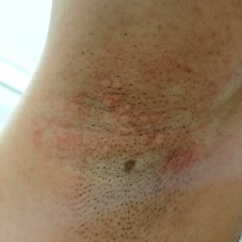 Driclor Koltuk Altımda Şiddetli Kaşıntı Ve Tahrişe Yol Açtı