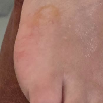 Duş Camı Kırıldı, Yaralandım Ve Otel Yönetimi İlgisiz Kaldı