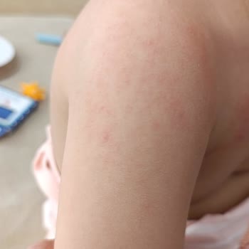 Bebekte Döküntüye Sebep Olan Şurup İçin Ücret İadesi Talebim Var