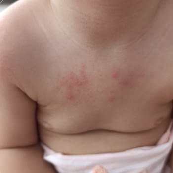 Bebekte Döküntüye Sebep Olan Şurup İçin Ücret İadesi Talebim Var