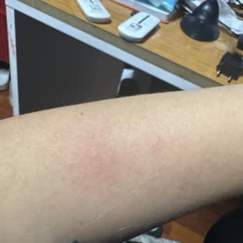 I Had Skin Rash and Itching After Using Off Mosquito Repellent Spray on My Arms