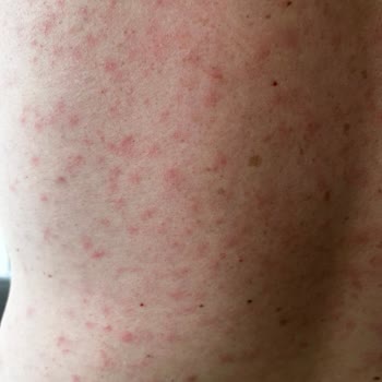 Cire Aseptine Güneş Kremi Sonrası Ciltte Alerjik Reaksiyon Ve Sivilce Oluşumu