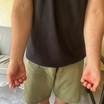 Cire Aseptine Güneş Kremi Sonrası Ciltte Alerjik Reaksiyon Ve Sivilce Oluşumu