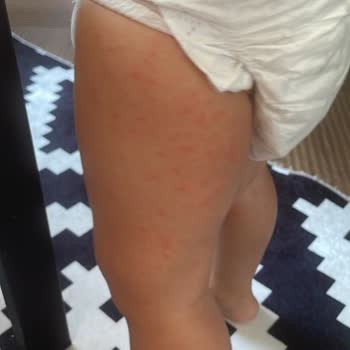 Otel Havuzundaki Hijyen Eksikliği Nedeniyle Çocuğum Hastalandı, Çözüm Bekliyorum