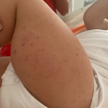 Otel Havuzundaki Hijyen Eksikliği Nedeniyle Çocuğum Hastalandı, Çözüm Bekliyorum