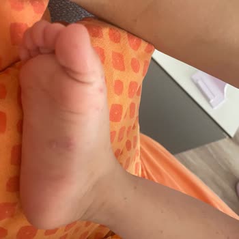 Otel Havuzundaki Hijyen Eksikliği Nedeniyle Çocuğum Hastalandı, Çözüm Bekliyorum