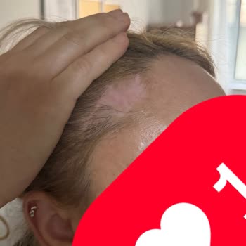 Ameliyat Sonrası Saç Kaybı Ve Enfeksiyon Mağduriyeti