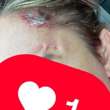 Ameliyat Sonrası Saç Kaybı Ve Enfeksiyon Mağduriyeti