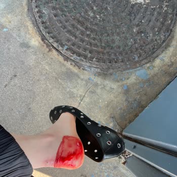 Aldığım Ayakkabının Ayağımı Kesmesi Sonucu Sağlık Sorunu Ve Mağduriyet Yaşadım