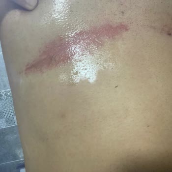 Tüy Dökücü Krem Cildimde Ciddi Tahrişe Yol Açtı