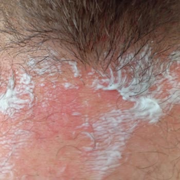 Agiss Sprey Tüy Dökücü Köpük Ciltte Yanma ve Tahrişe Sebep Oldu