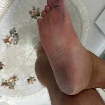 Aldığım Orijinal Terliğin Boyası Ayağıma Çıkıyor, İade Talebim Reddedildi