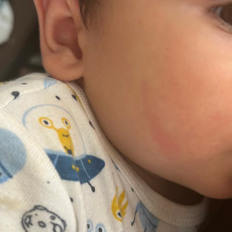 Atopik Ciltler İçin Olan Krem Bebeğimde Alerjik Reaksiyona Sebep Oldu