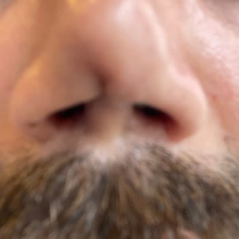 Estetik Burun Ameliyatı Sonrası Kalıcı Mağduriyet Ve İletişimsizlik