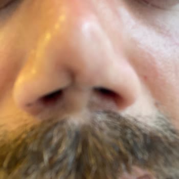 Estetik Burun Ameliyatı Sonrası Kalıcı Mağduriyet Ve İletişimsizlik