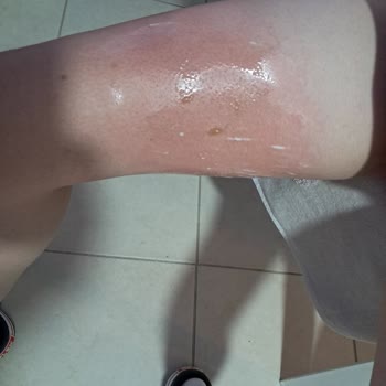 Karton Bardak Noodle Sıcak Ürünle Çocuğumun Yanmasına Sebep Oldu